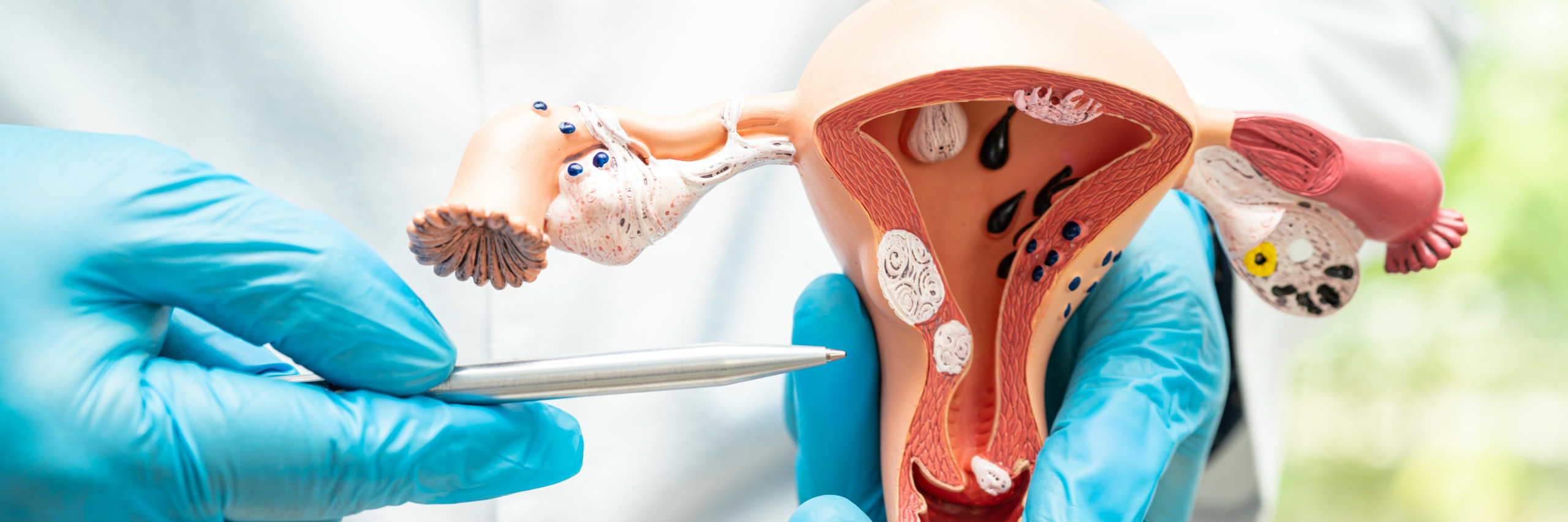 médico sugentándo un modelo anatómico de útero
